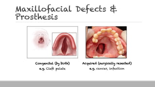 Maxillofacial Defects &
Prosthesis
Congenital (by birth)
e.g. Cleft palate
Acquired (surgically resected)
e.g. cancer, infection
 