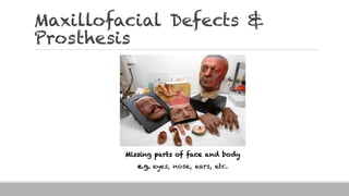 Maxillofacial Defects &
Prosthesis
Missing parts of face and body
e.g. eyes, nose, ears, etc.
 