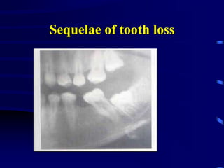 Sequelae of tooth loss
 