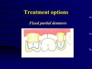 Treatment options
Fixed partial dentures
 