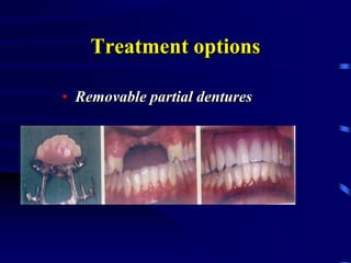 Treatment options
• Removable partial dentures
 