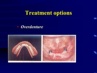 Treatment options
• Overdenture
 