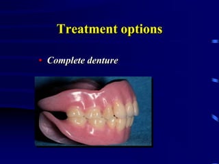 Treatment options
• Complete denture
 