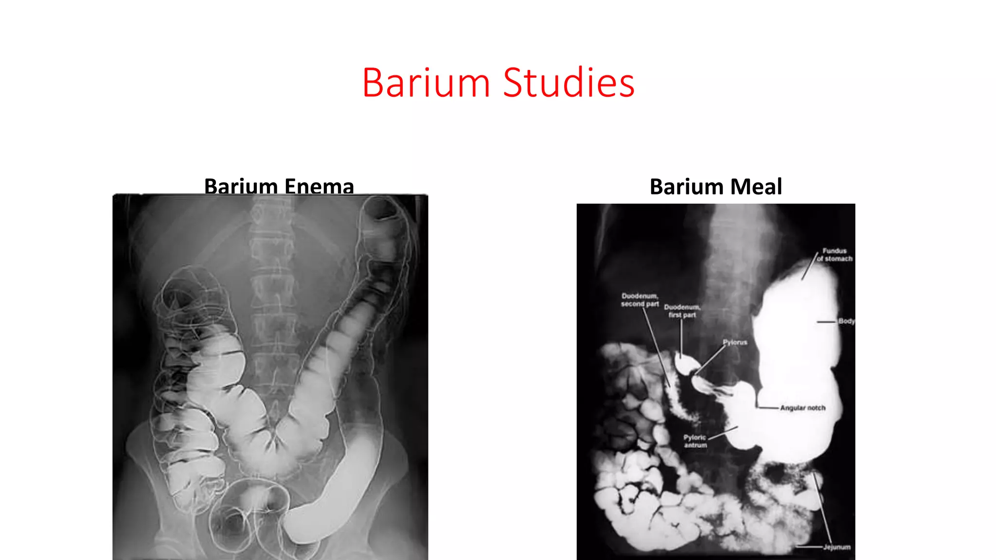 Barium Studies
Barium Enema Barium Meal