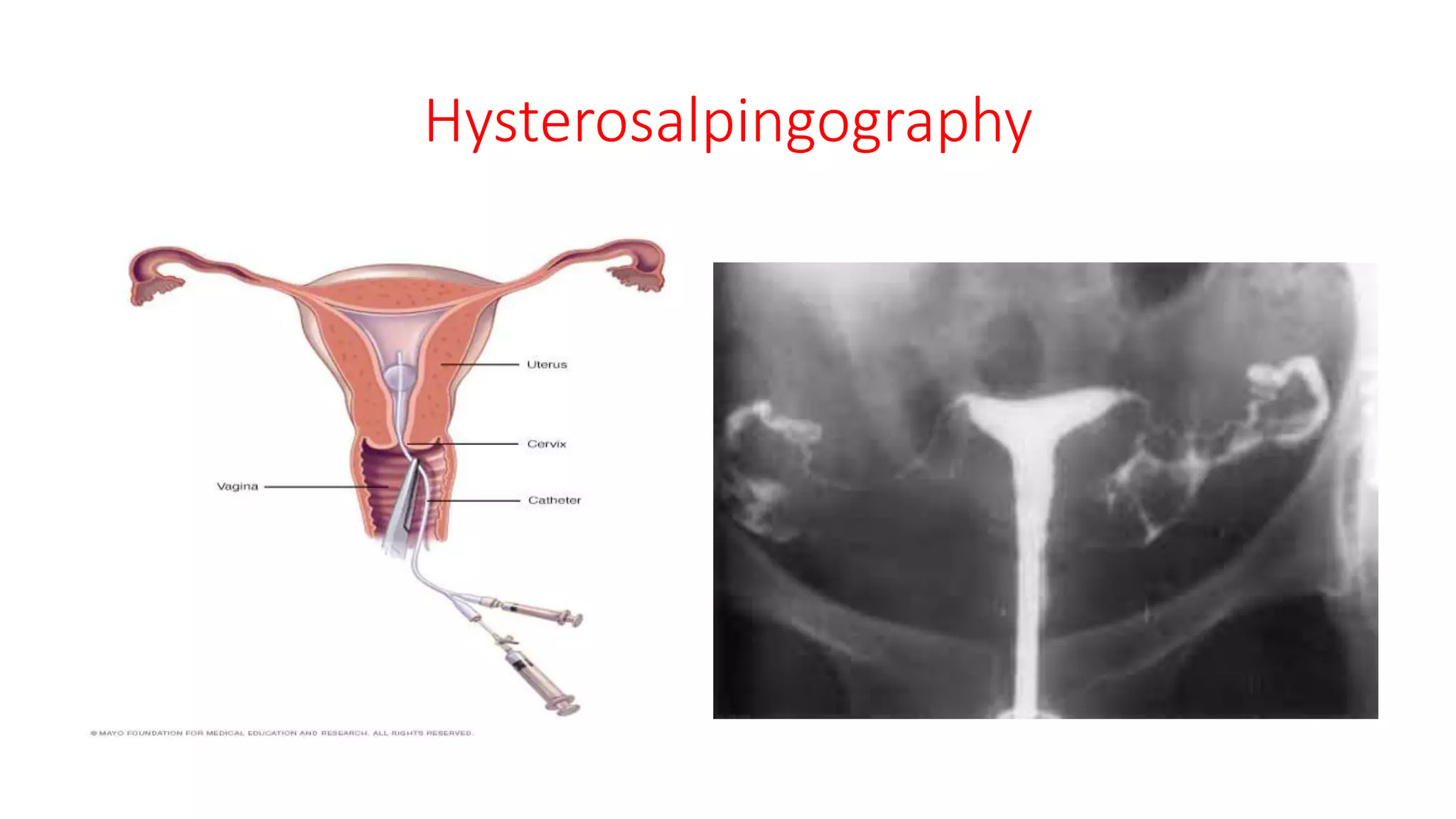 Hysterosalpingography