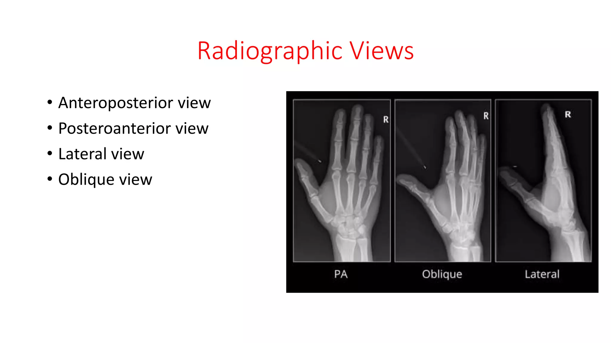 Radiographic Views
• Anteroposterior view
• Posteroanterior view
• Lateral view
• Oblique view