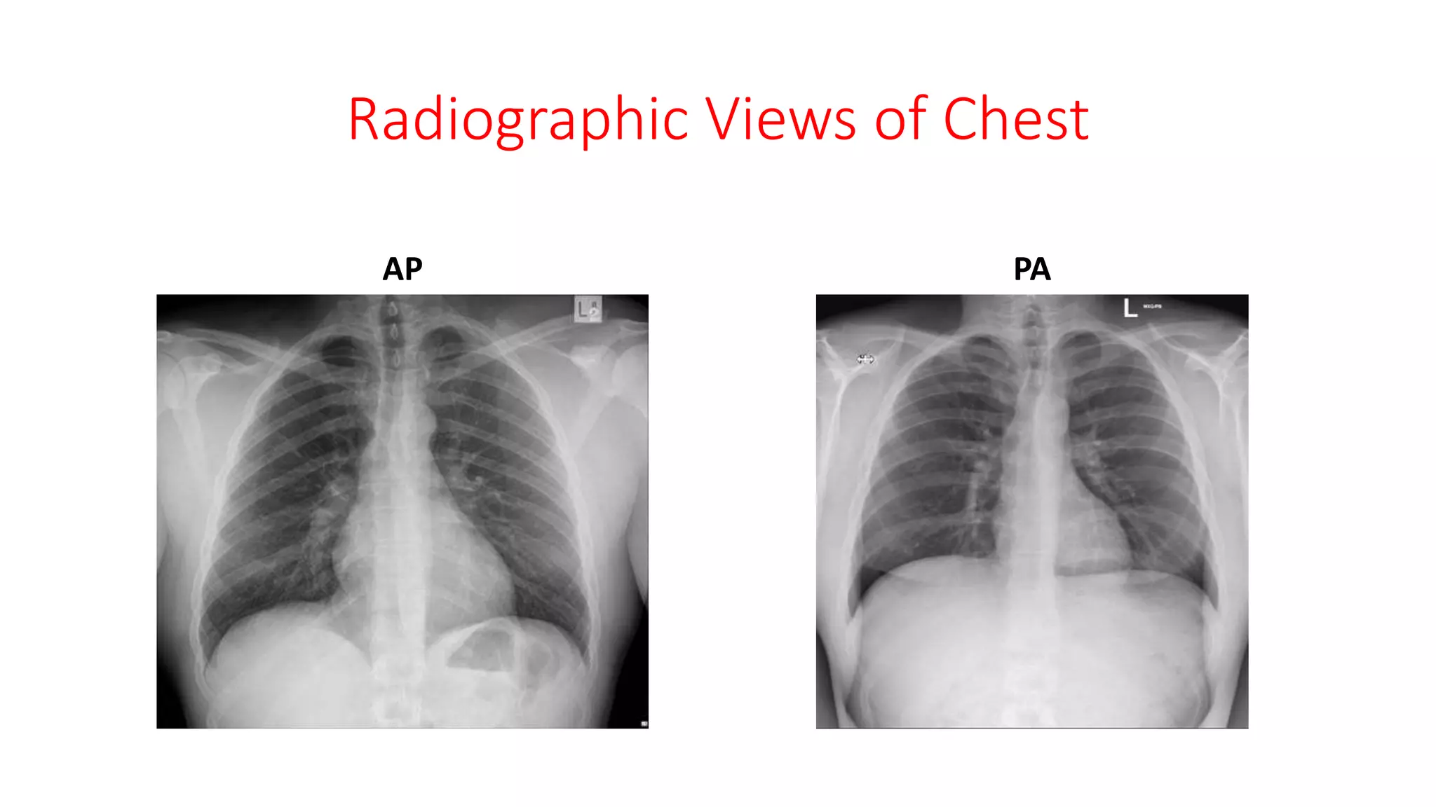 Radiographic Views of Chest
AP PA