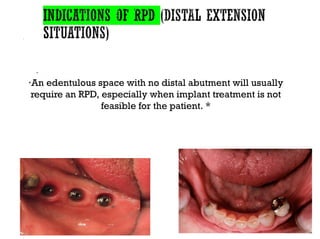 ·
·An edentulous space with no distal abutment will usually
require an RPD, especially when implant treatment is not
feasible for the patient. *
 