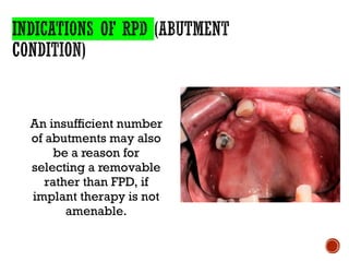 An insufficient number
of abutments may also
be a reason for
selecting a removable
rather than FPD, if
implant therapy is not
amenable.
 