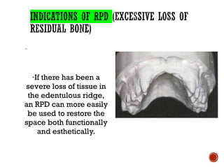 ·
·If there has been a
severe loss of tissue in
the edentulous ridge,
an RPD can more easily
be used to restore the
space both functionally
and esthetically.
 
