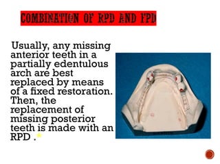 Usually, any missing
anterior teeth in a
partially edentulous
arch are best
replaced by means
of a fixed restoration.
Then, the
replacement of
missing posterior
teeth is made with an
RPD .*
 
