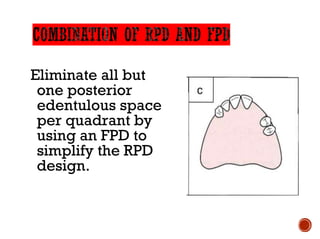 Eliminate all but
one posterior
edentulous space
per quadrant by
using an FPD to
simplify the RPD
design.
 