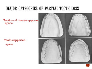 Tooth- and tissue-supported
space
Tooth-supported
space
 
