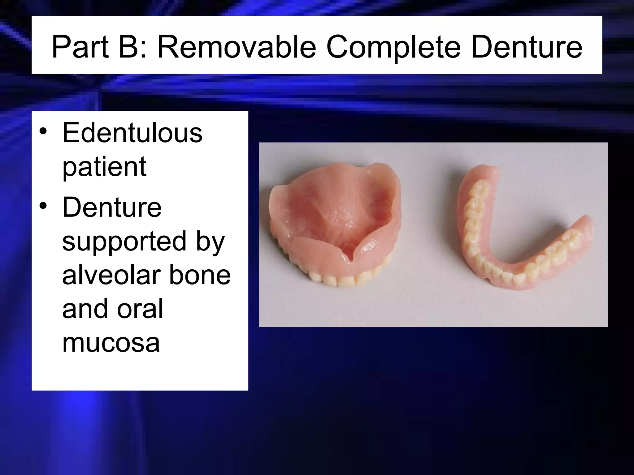 Part B: Removable Complete Denture Edentulous patient Denture supported by alveolar bone and oral mucosa 