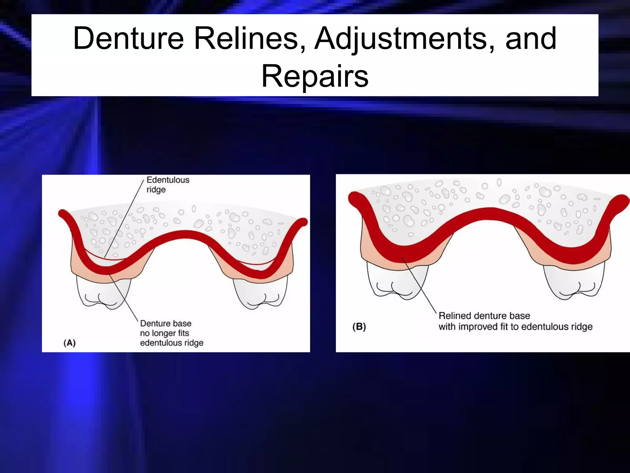 Denture Relines, Adjustments, and Repairs 