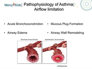 Pathophysiology of Asthma;
Airflow limitation
• Acute Bronchoconstriction
• Airway Edema
• Mucous Plug Formation
• Airway Wall Remodeling
 