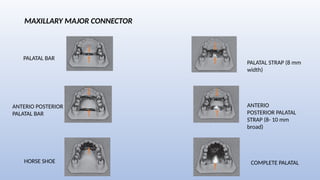 Posterier Strap Rpd Introduction to Removable Partial Dentures | PPTX