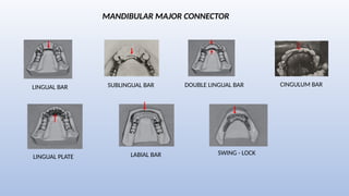 Introduction to Removable Partial Dentures | PPTX
