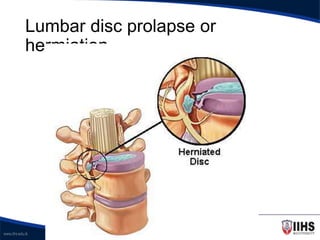 Disc Prolapse Classification Introduction to Skeletal System anatomy | PPT