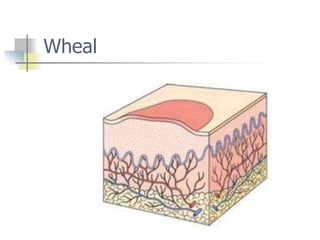Wheals Examples Introduction to skin and various skin conditions. | PPT