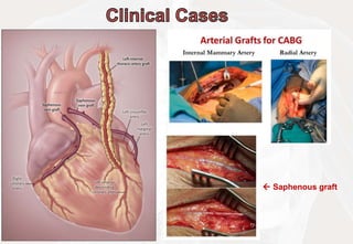 Saphenous graft

 