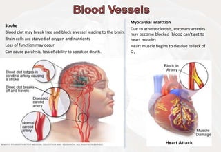 Myocardial infarction
Due to atherosclerosis, coronary arteries
may become blocked (blood can’t get to
heart muscle)
Heart muscle begins to die due to lack of
O2
Stroke
Blood clot may break free and block a vessel leading to the brain.
Brain cells are starved of oxygen and nutrients
Loss of function may occur
Can cause paralysis, loss of ability to speak or death.
 