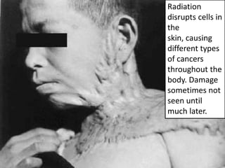 Radiation
disrupts cells in
the
skin, causing
different types
of cancers
throughout the
body. Damage
sometimes not
seen until
much later.
 