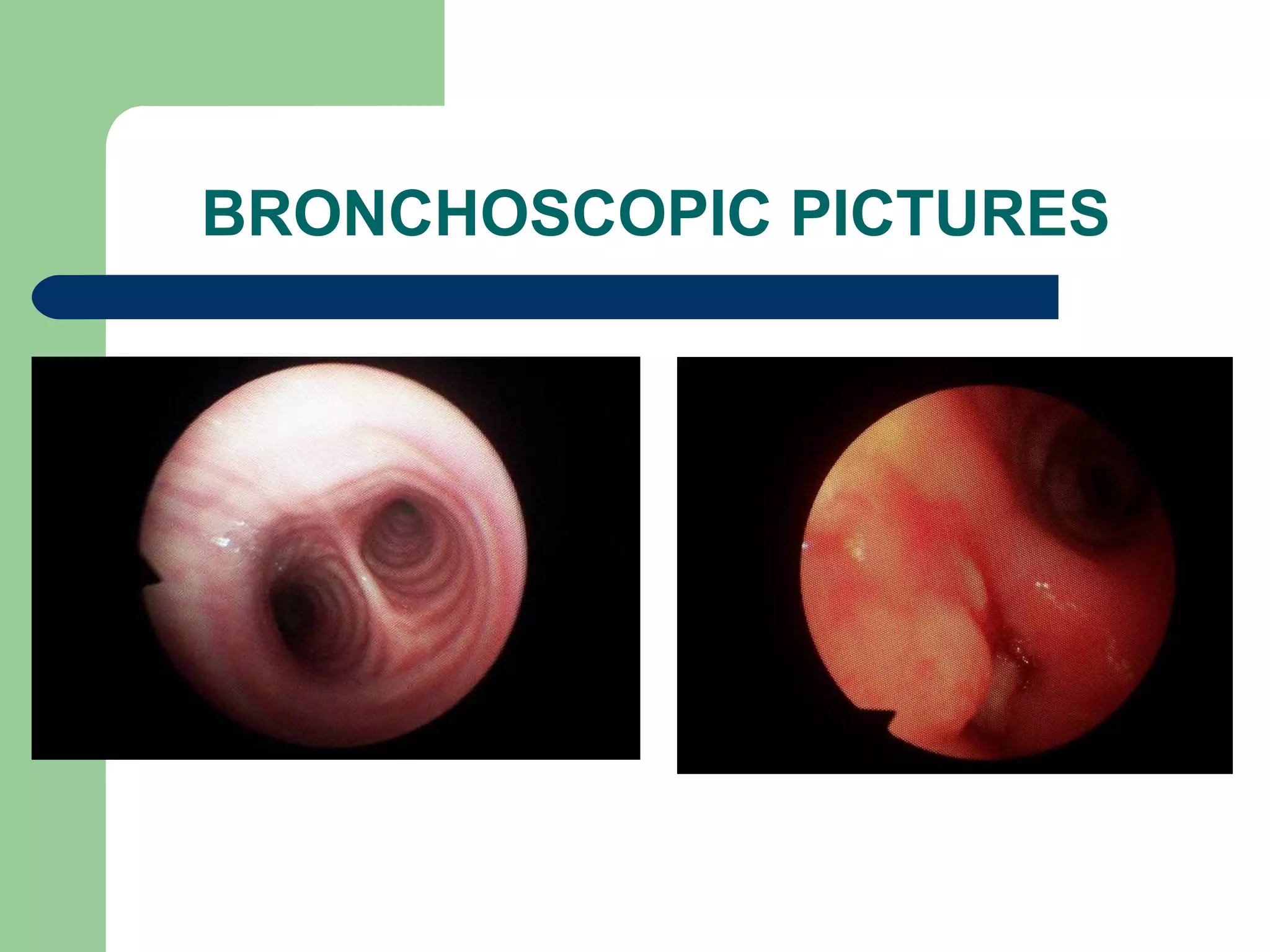 BRONCHOSCOPIC PICTURES 
 