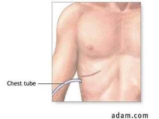 Chest Operation Introduction to thoracic surgery | PPT