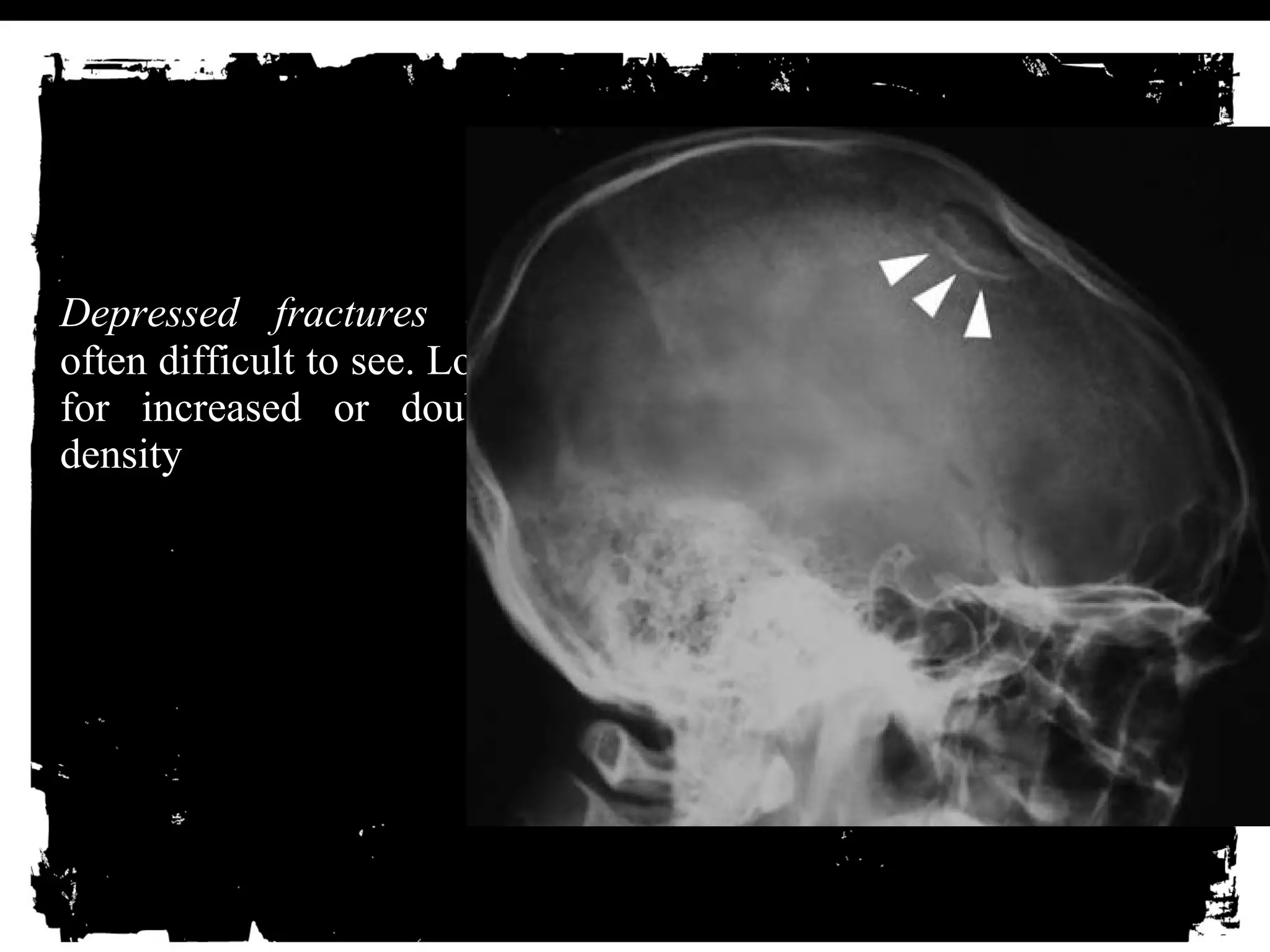 Depressed fractures are 
often difficult to see. Look 
for increased or double 
density 
 