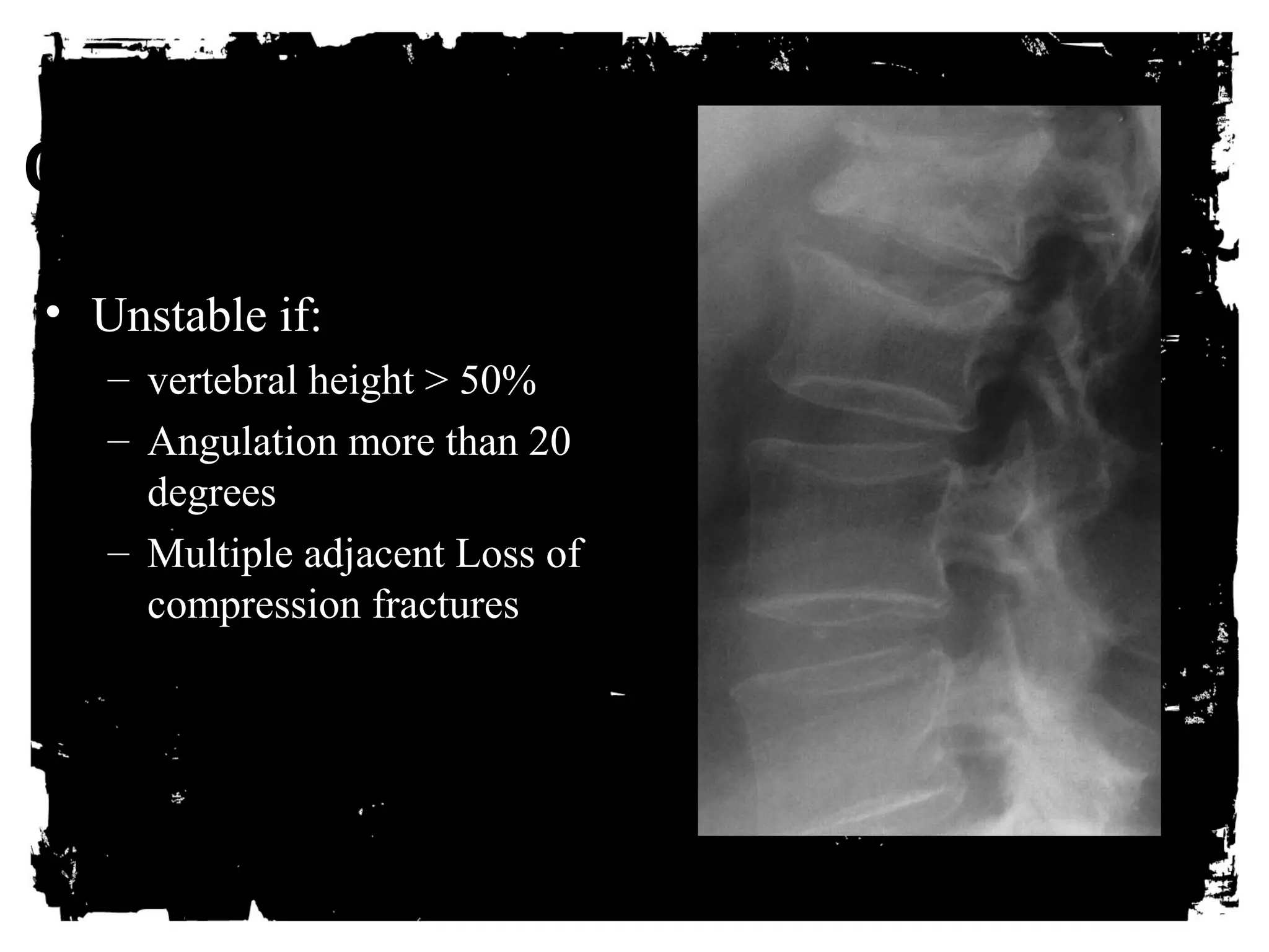 CLICK HERE TO ADD TEXT 
• Unstable if: 
– vertebral height > 50% 
– Angulation more than 20 
degrees 
– Multiple adjacent Loss of 
compression fractures 
 