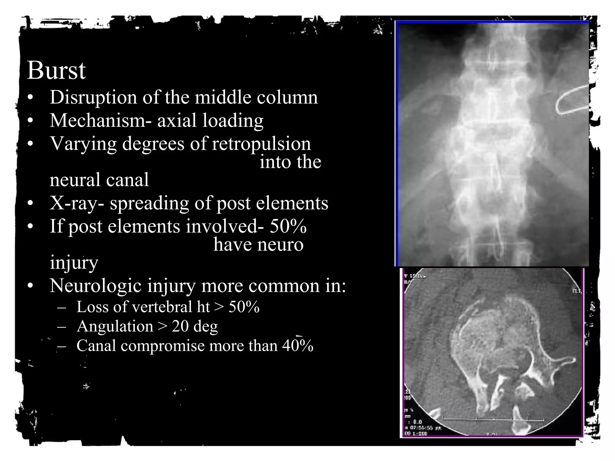 Burst 
• Disruption of the middle column 
• Mechanism- axial loading 
• Varying degrees of retropulsion 
into the 
neural canal 
• X-ray- spreading of post elements 
• If post elements involved- 50% 
have neuro 
injury 
• Neurologic injury more common in: 
– Loss of vertebral ht > 50% 
– Angulation > 20 deg 
– Canal compromise more than 40% 
 