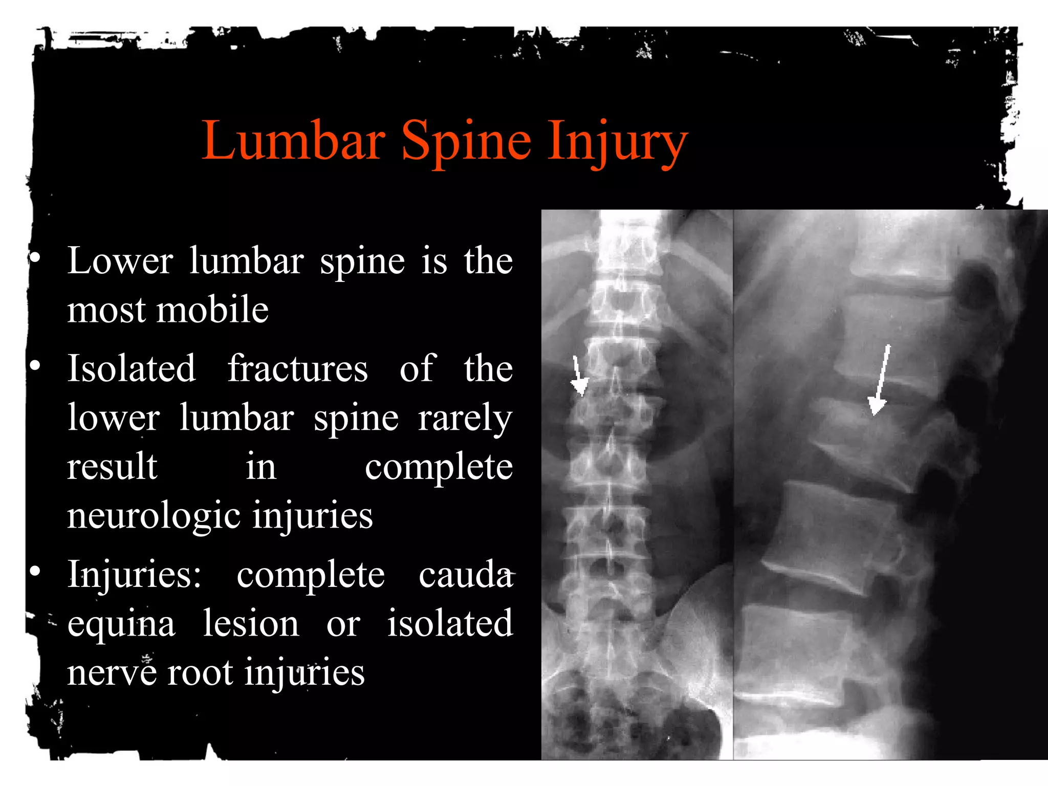 Lumbar Spine Injury 
• Lower lumbar spine is the 
most mobile 
• Isolated fractures of the 
lower lumbar spine rarely 
result in complete 
neurologic injuries 
• Injuries: complete cauda 
equina lesion or isolated 
nerve root injuries 
 