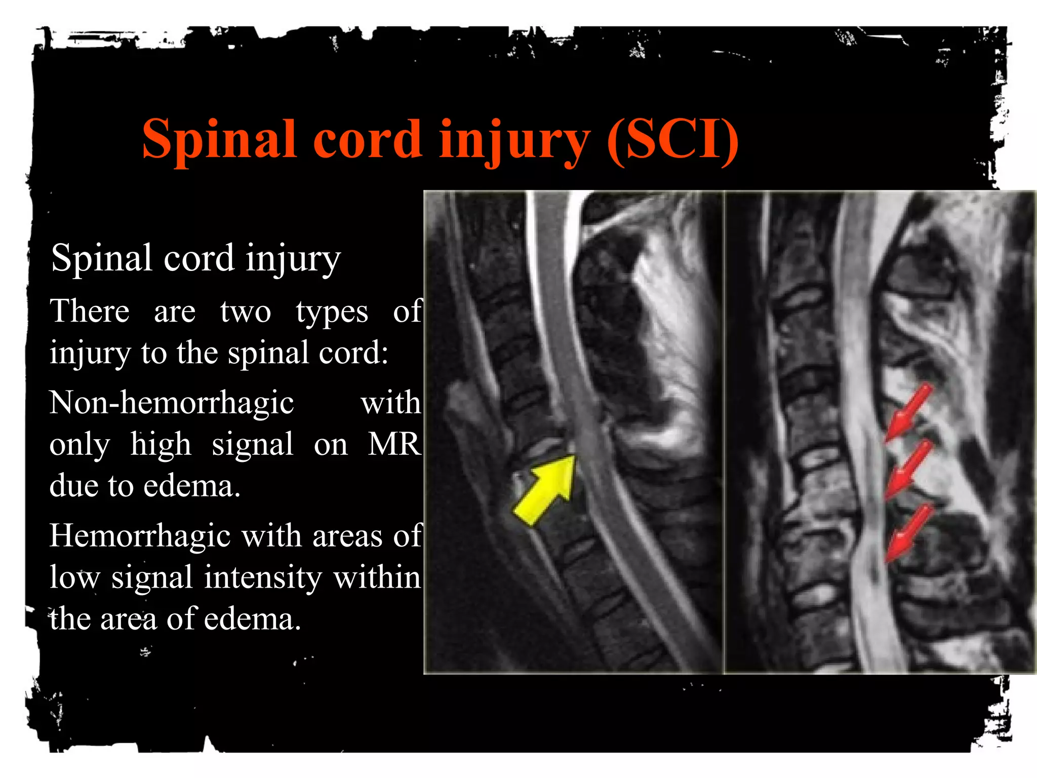 Spinal cord injury (SCI) 
Spinal cord injury 
There are two types of 
injury to the spinal cord: 
• Non-hemorrhagic with 
only high signal on MR 
due to edema. 
• Hemorrhagic with areas of 
low signal intensity within 
the area of edema. 
 