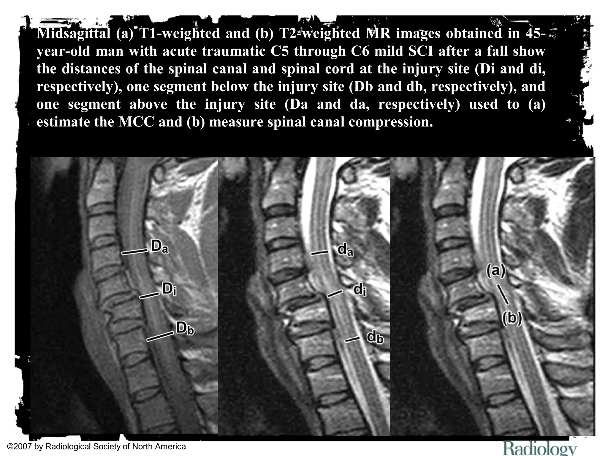 Midsagittal (a) T1-weighted and (b) T2-weighted MR images obtained in 45- 
year-old man with acute traumatic C5 through C6 mild SCI after a fall show 
the distances of the spinal canal and spinal cord at the injury site (Di and di, 
respectively), one segment below the injury site (Db and db, respectively), and 
one segment above the injury site (Da and da, respectively) used to (a) 
estimate the MCC and (b) measure spinal canal compression. 
©2007 by Radiological Society of North America 
 