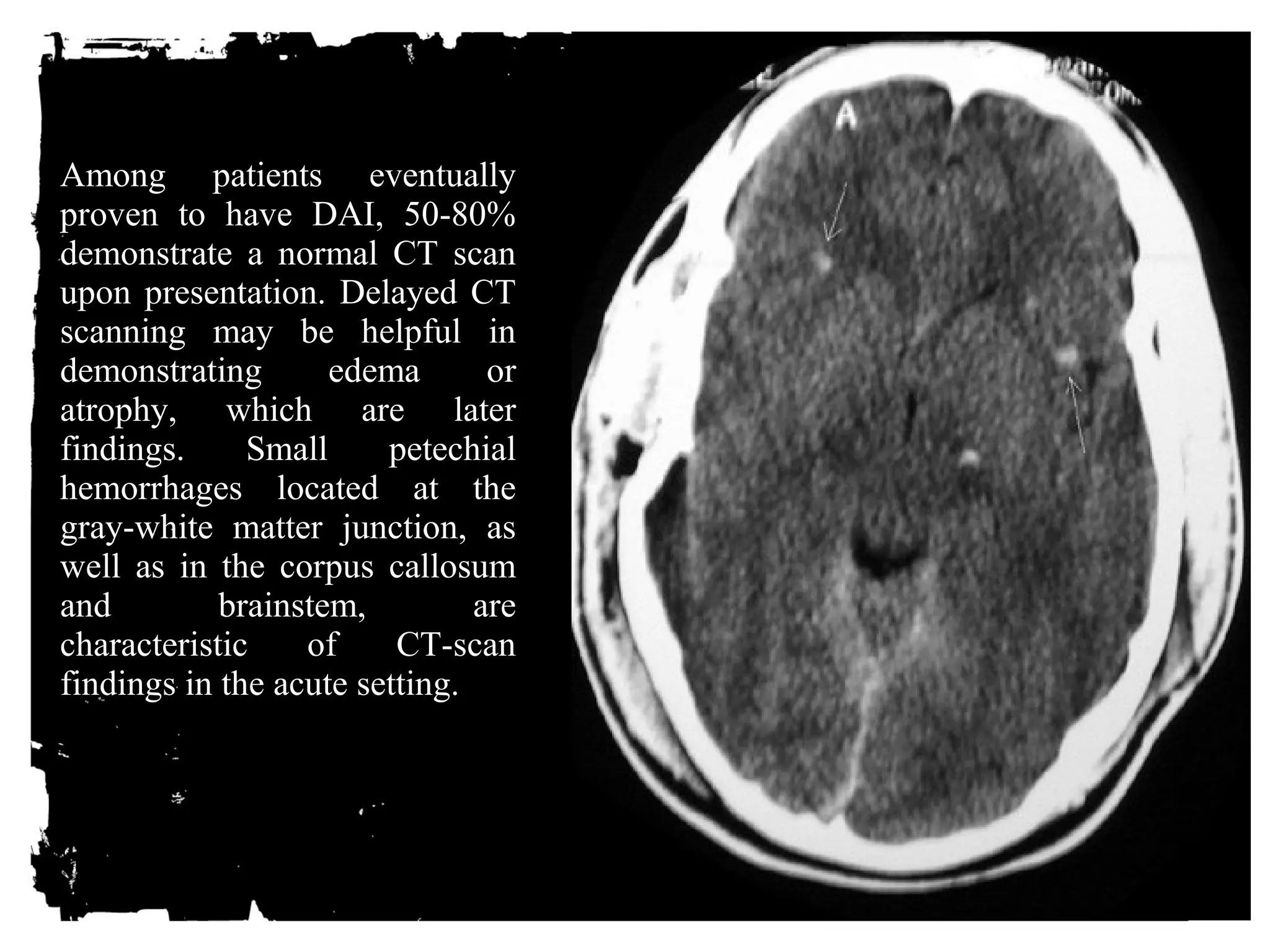 Among patients eventually 
proven to have DAI, 50-80% 
demonstrate a normal CT scan 
upon presentation. Delayed CT 
scanning may be helpful in 
demonstrating edema or 
atrophy, which are later 
findings. Small petechial 
hemorrhages located at the 
gray-white matter junction, as 
well as in the corpus callosum 
and brainstem, are 
characteristic of CT-scan 
findings in the acute setting. 
 