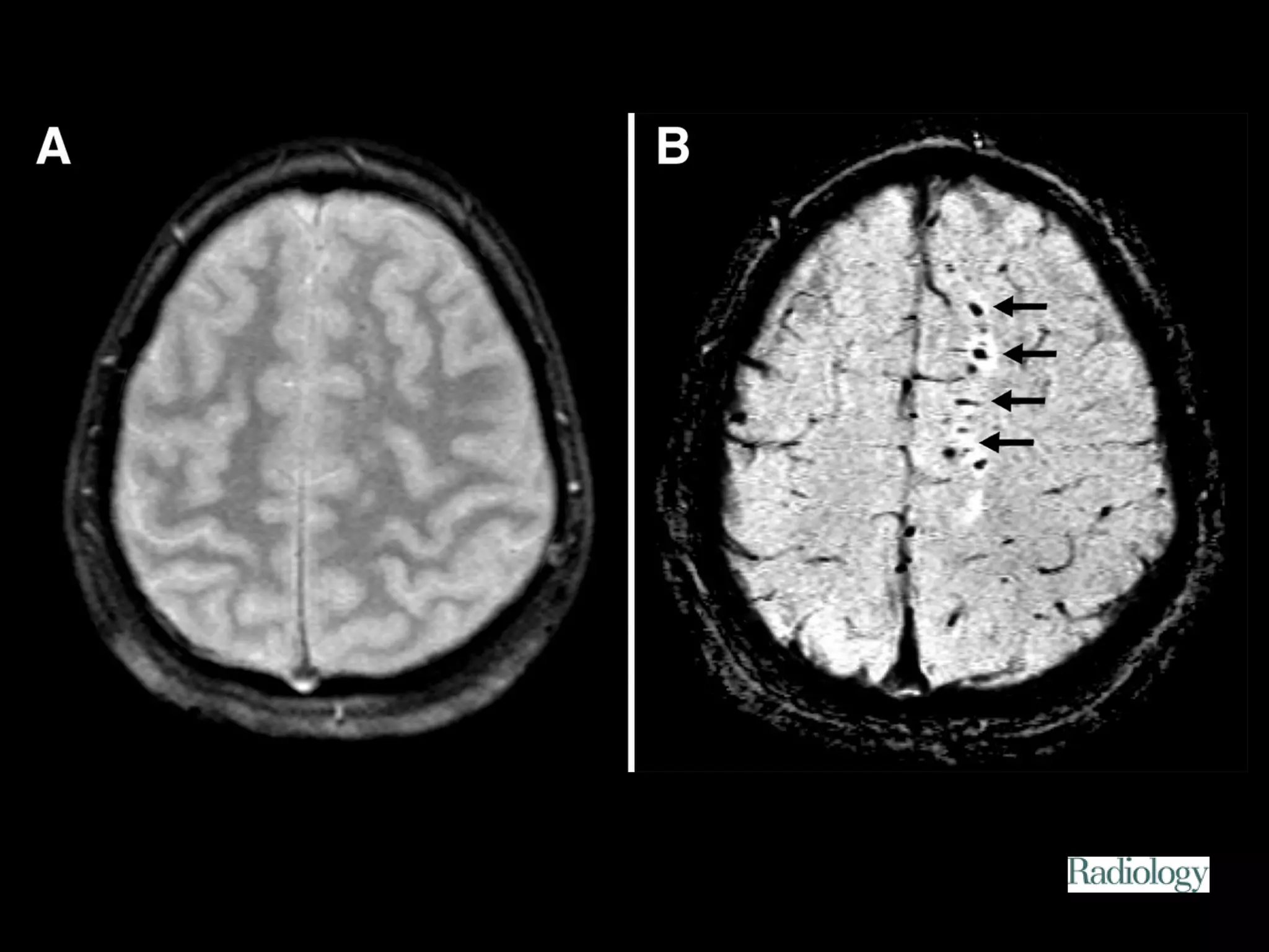 Figure 1. Patient 2. 
Tong K A et al. Radiology 2003;227:332-339 
©2003 by Radiological Society of North America 
 