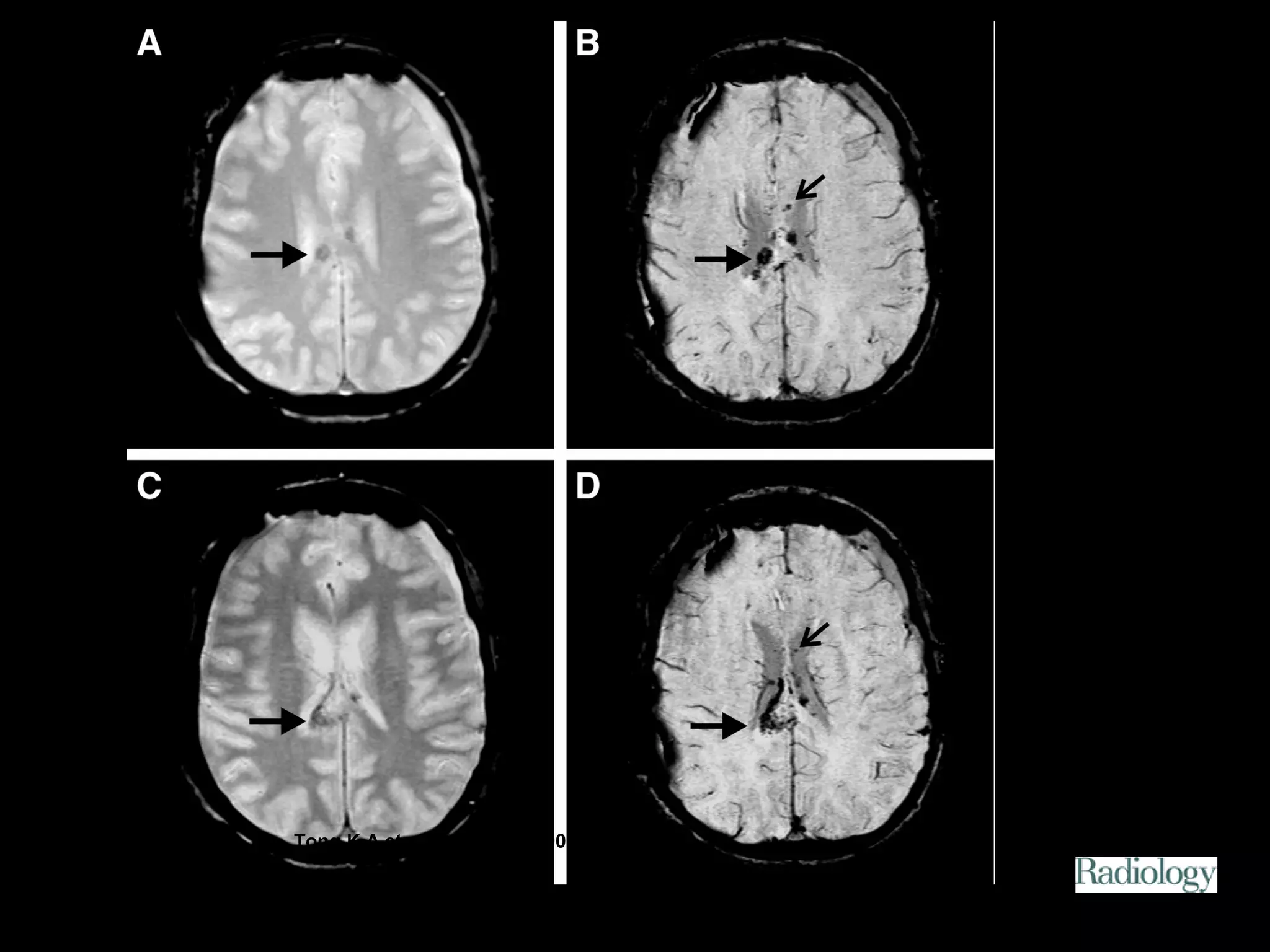 Figure 2. Patient 4. 
Tong K A et al. Radiology 2003;227:332-339 
©2003 by Radiological Society of North America 
 