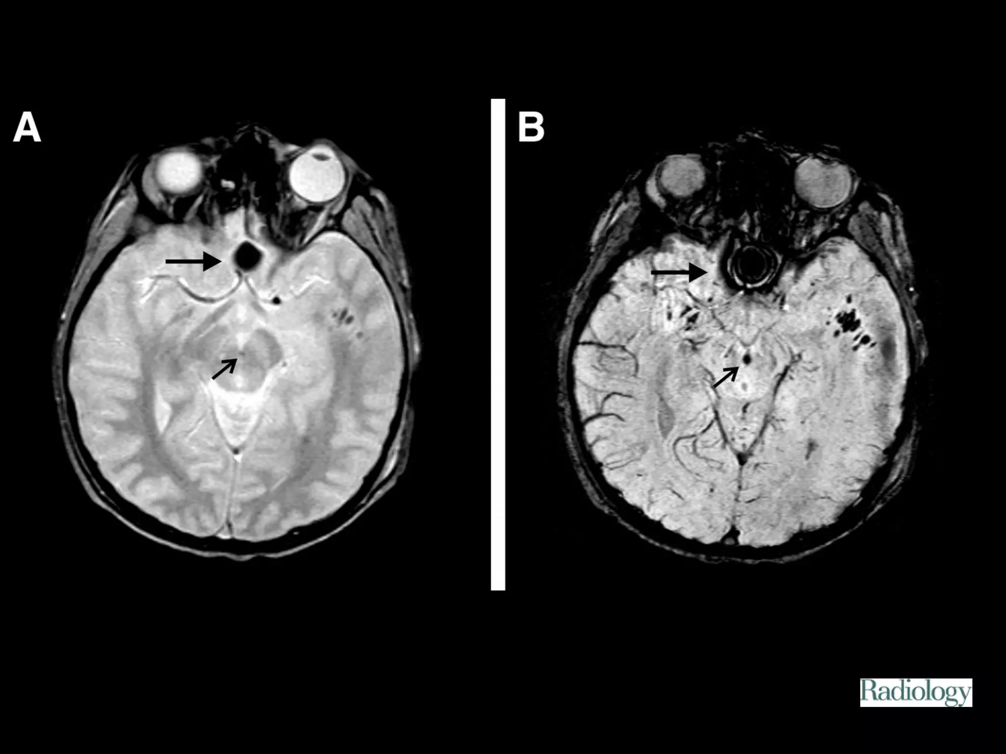 Figure 3. Patient 2. 
Tong K A et al. Radiology 2003;227:332-339 
©2003 by Radiological Society of North America 
 