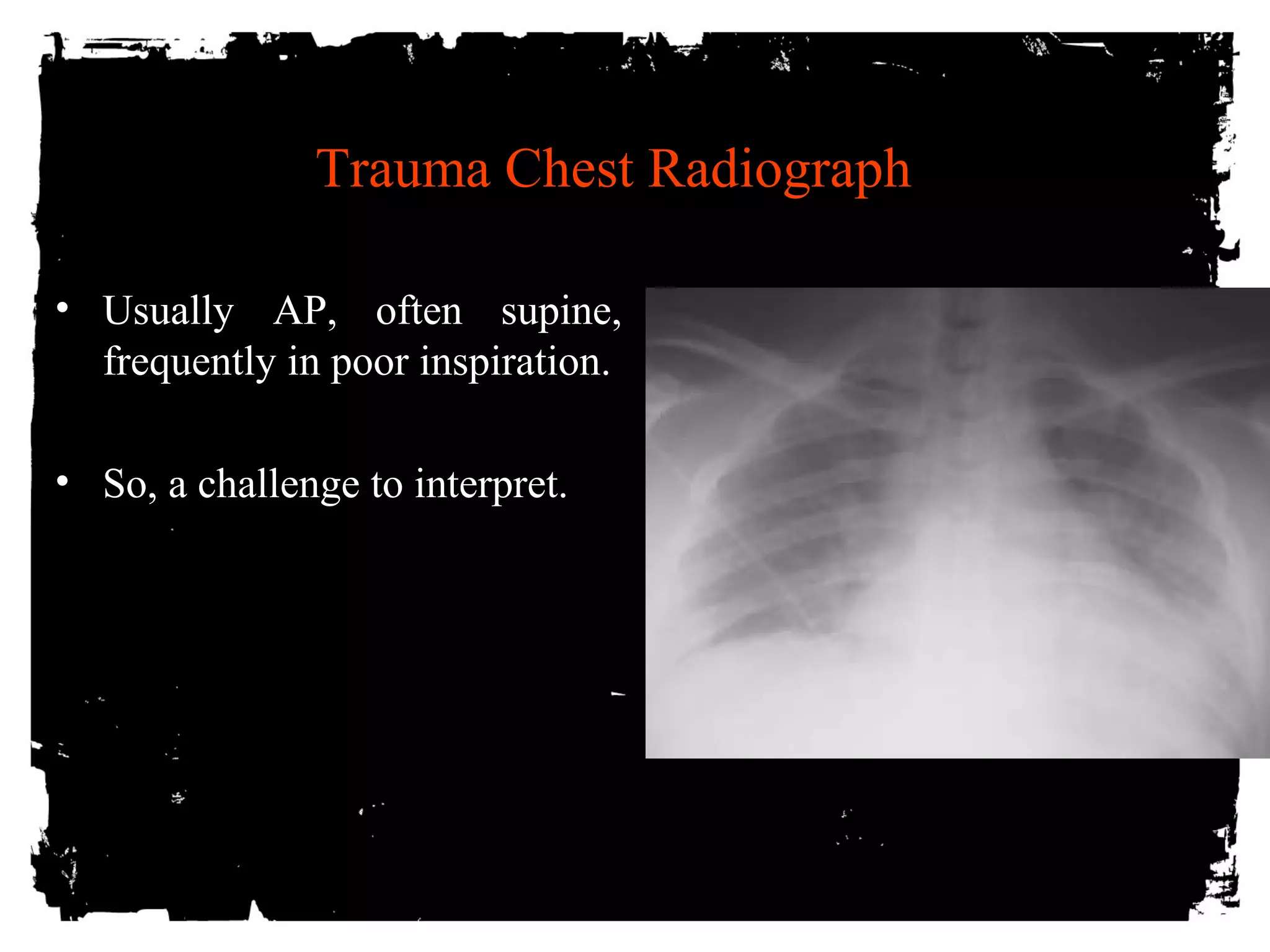 Trauma Chest Radiograph 
• Usually AP, often supine, 
frequently in poor inspiration. 
• So, a challenge to interpret. 
 