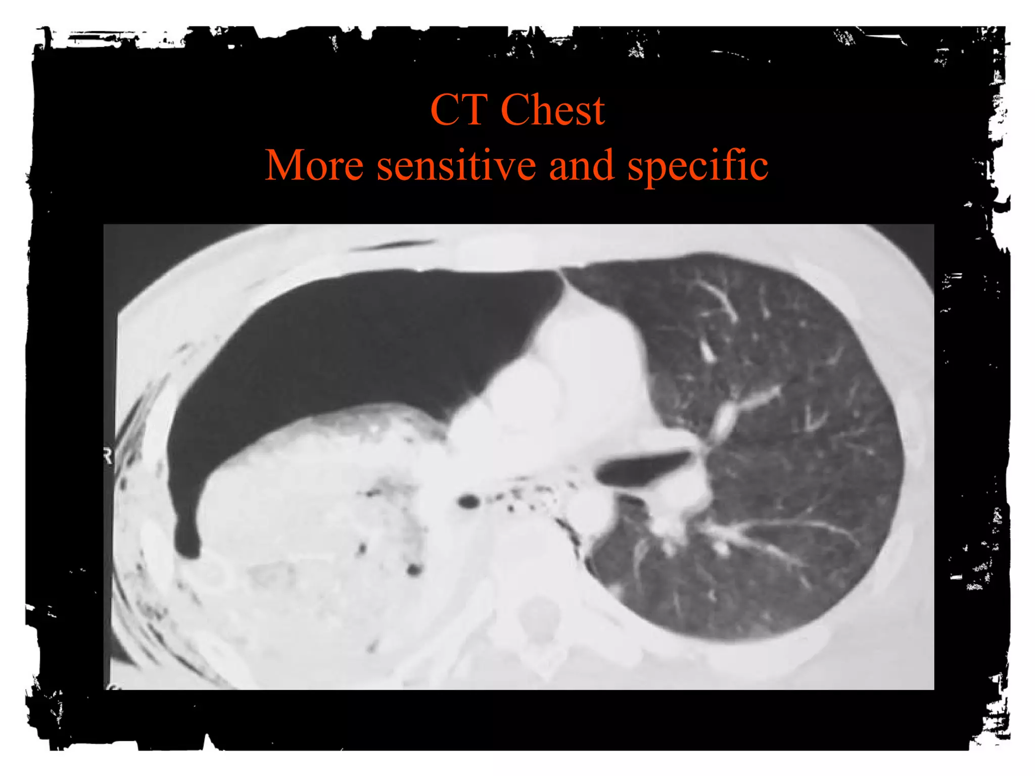 CT Chest 
More sensitive and specific 
 