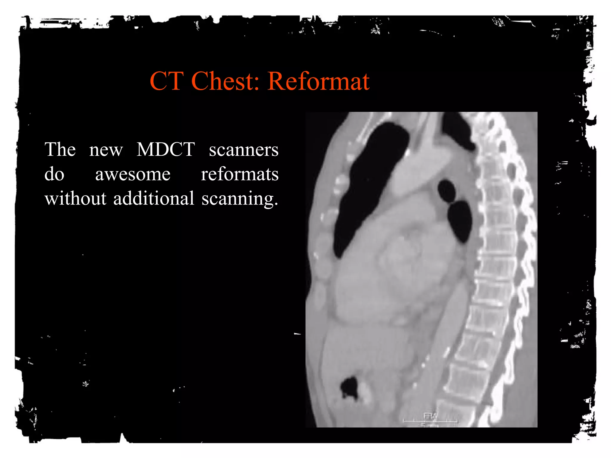 CT Chest: Reformat 
The new MDCT scanners 
do awesome reformats 
without additional scanning. 
 