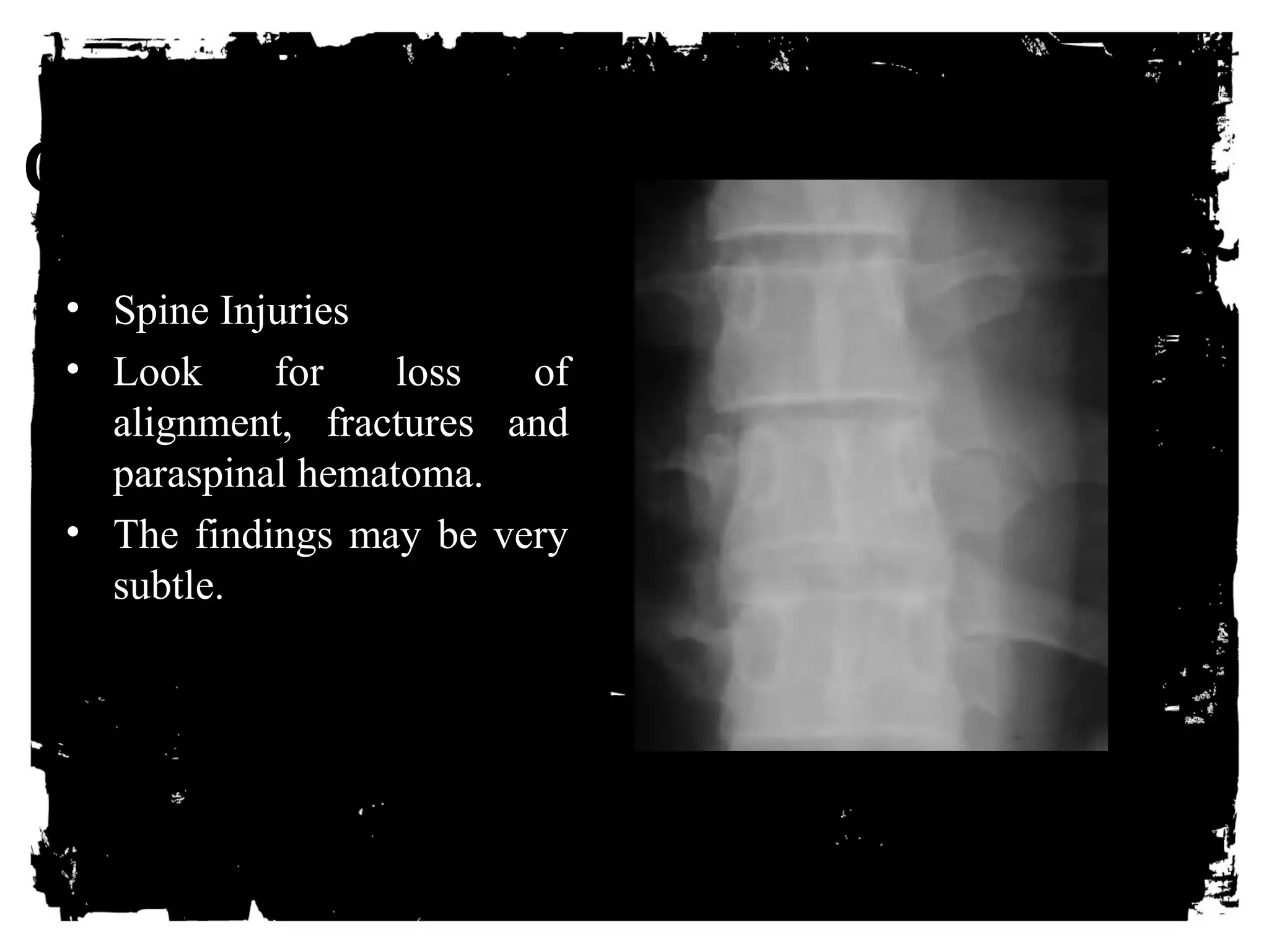 CLICK HERE TO ADD TEXT 
• Spine Injuries 
• Look for loss of 
alignment, fractures and 
paraspinal hematoma. 
• The findings may be very 
subtle. 
 