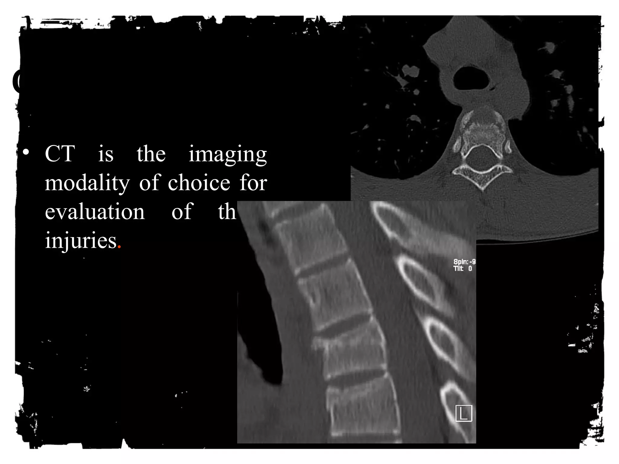 CLICK HERE TO ADD TEXT 
• CT is the imaging 
modality of choice for 
evaluation of these 
injuries. 
 