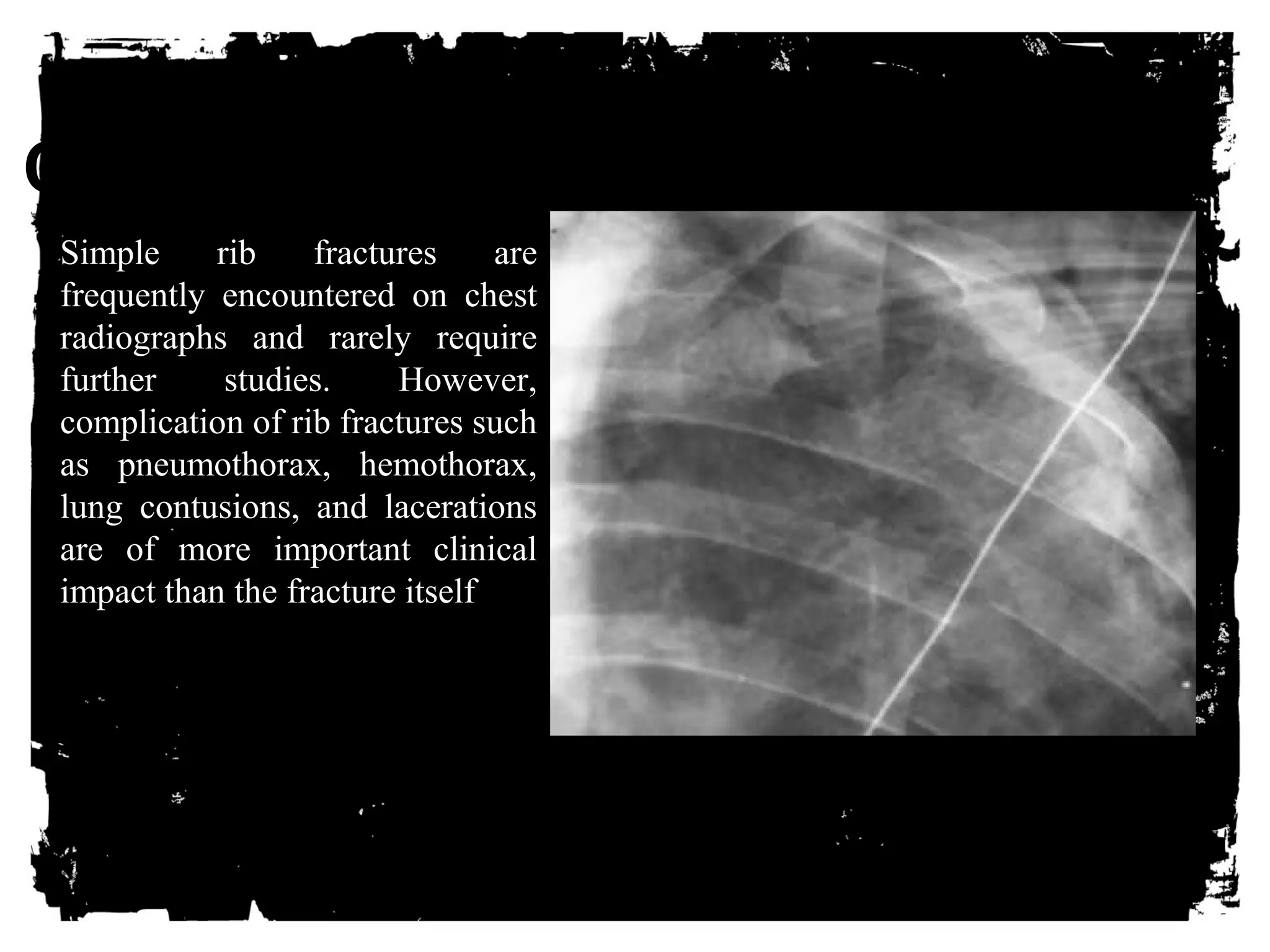 CLICK HERE TO ADD TEXT 
Simple rib fractures are 
frequently encountered on chest 
radiographs and rarely require 
further studies. However, 
complication of rib fractures such 
as pneumothorax, hemothorax, 
lung contusions, and lacerations 
are of more important clinical 
impact than the fracture itself 
 