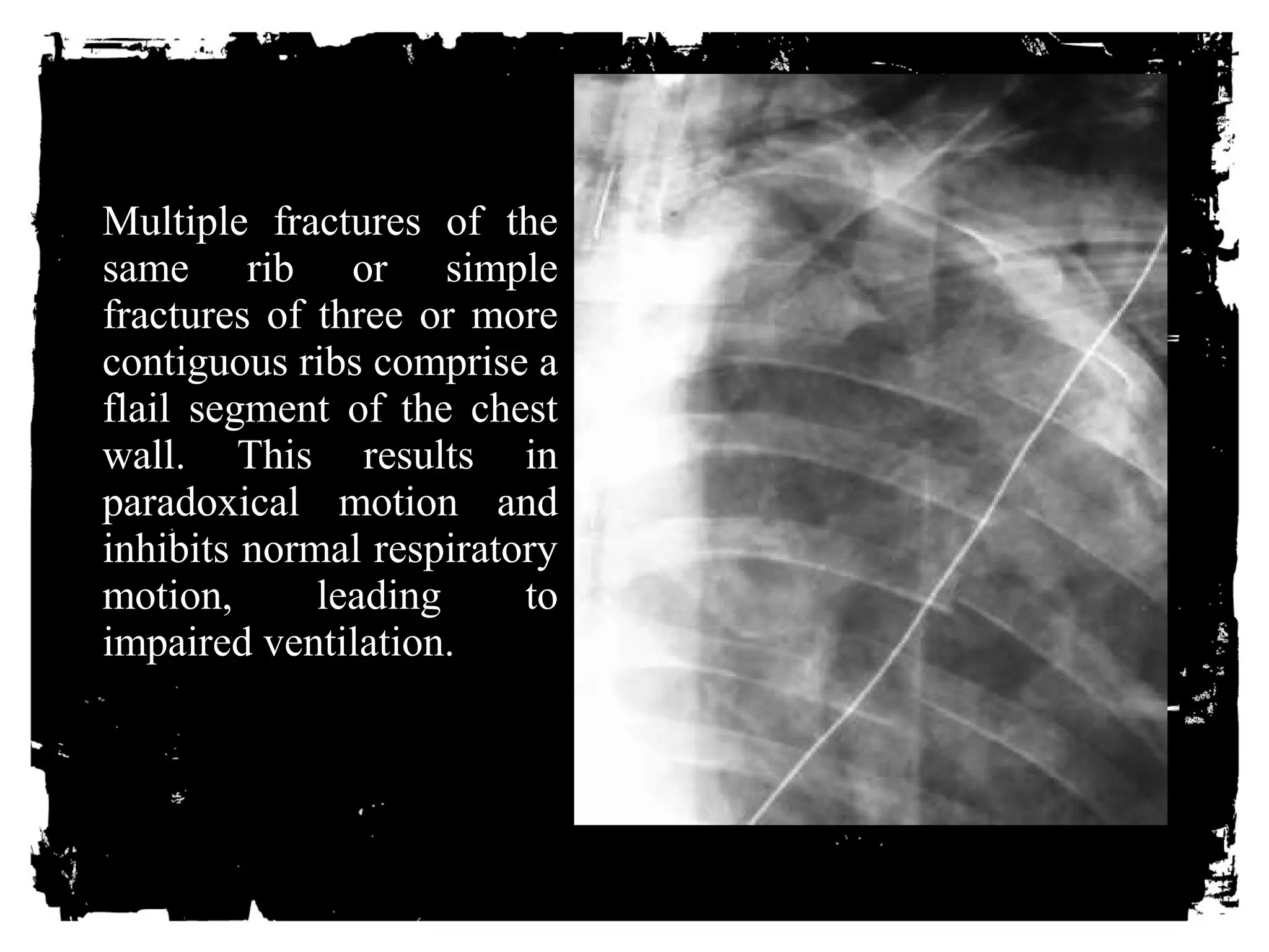 Multiple fractures of the 
same rib or simple 
fractures of three or more 
contiguous ribs comprise a 
flail segment of the chest 
wall. This results in 
paradoxical motion and 
inhibits normal respiratory 
motion, leading to 
impaired ventilation. 
 