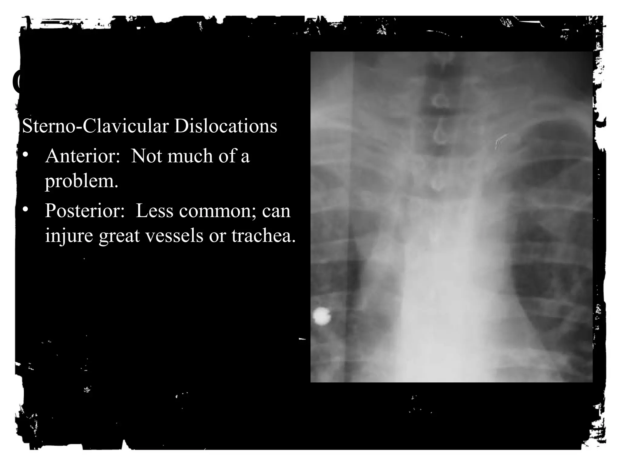CLICK HERE TO ADD TEXT 
Sterno-Clavicular Dislocations 
• Anterior: Not much of a 
problem. 
• Posterior: Less common; can 
injure great vessels or trachea. 
 