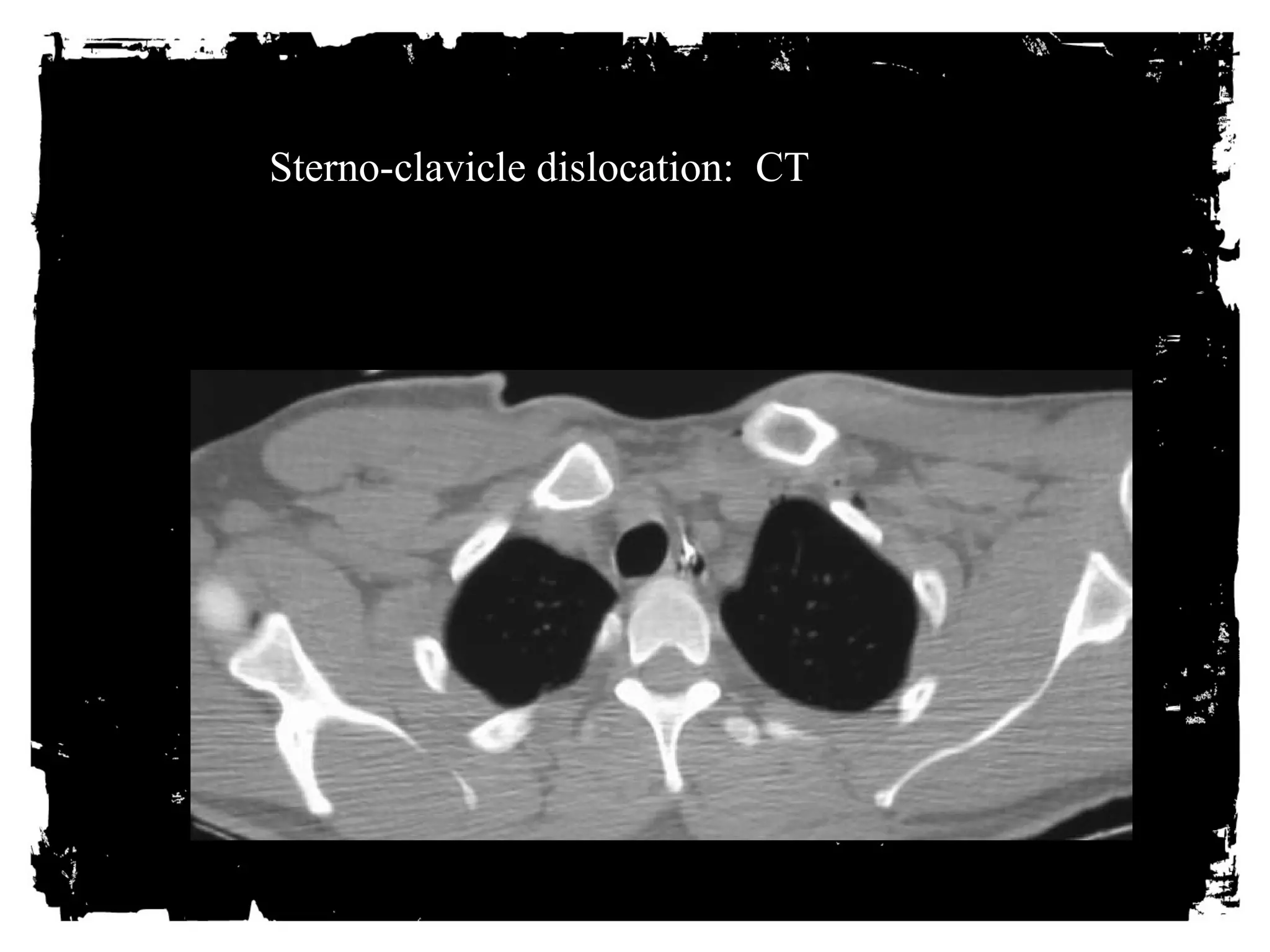 Sterno-clavicle dislocation: CT 
Click here to add text. Click here to add text. Click here to add text. Click 
here to add text. Click here to add text. Click here to add text. Click here 
to add text. Click here to add text. Click here to add text. Click here to 
add text. Click here to add text. Click here to add text. Click here to add 
text. Click here to add text. Click here to add text. Click here to add text. 
Click here to add text. Click here to add text. Click here to add text. Click 
here to add text. Click here to add text. Click here to add text. Click here 
to add text. Click here to add text. Click here to add text. Click here to 
add text. Click here to add text. Click here to add text. 
 