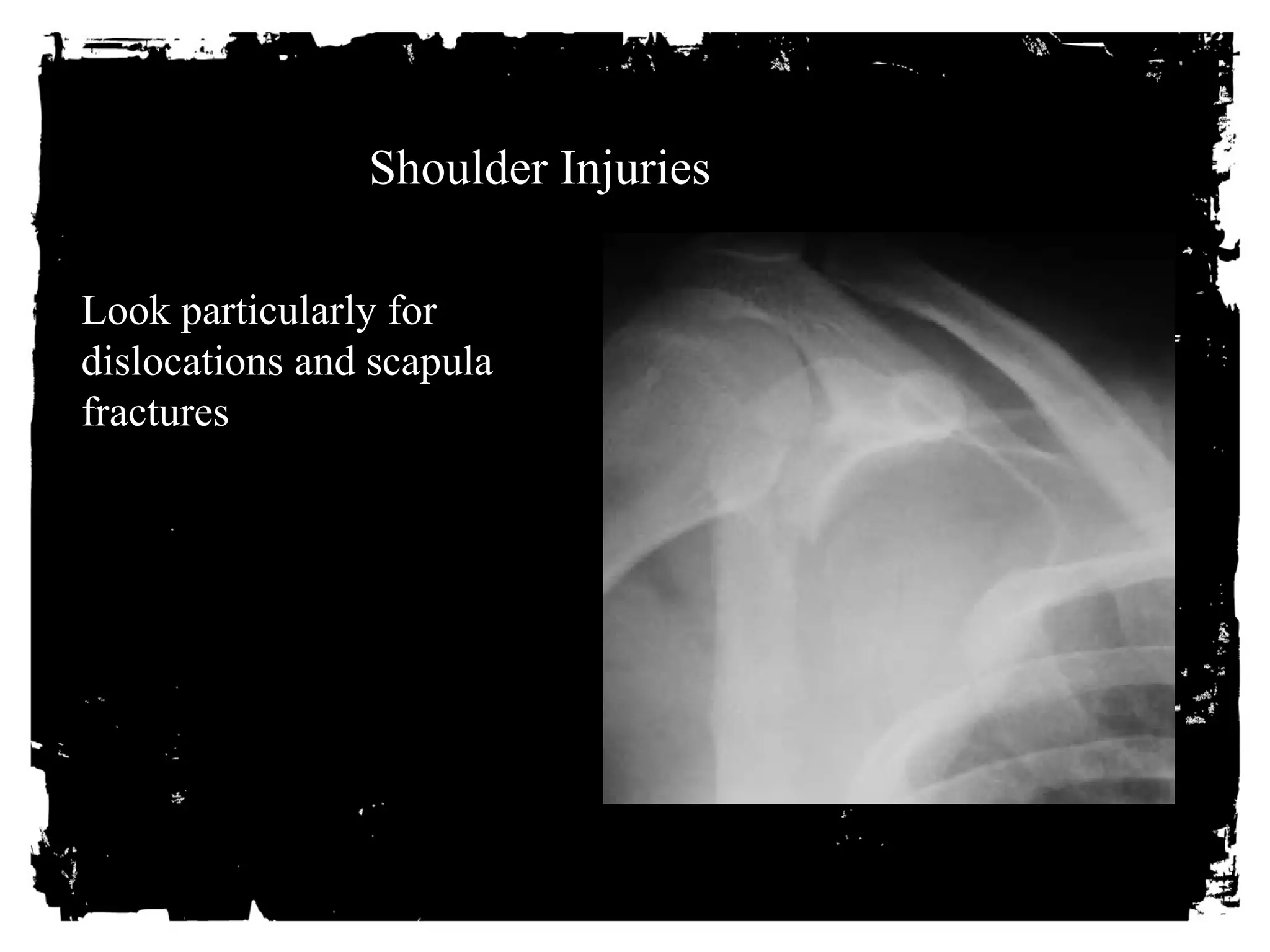 Shoulder Injuries 
Look particularly for 
dislocations and scapula 
fractures 
 