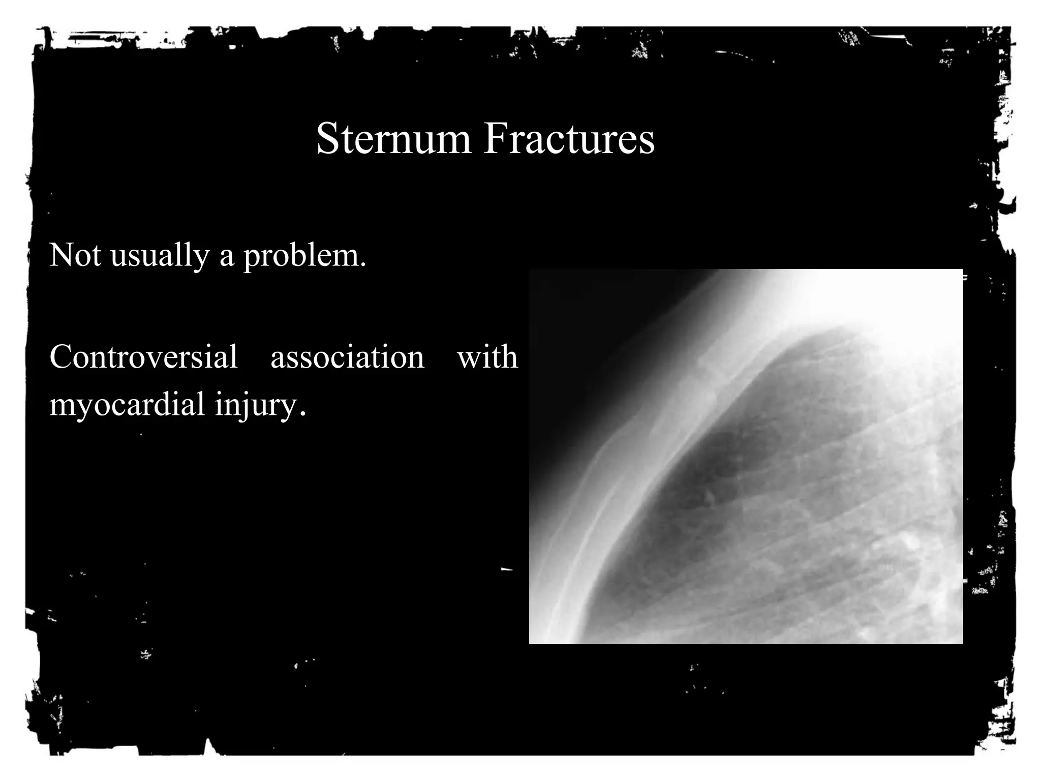 Sternum Fractures 
• Not usually a problem. 
• Controversial association with 
myocardial injury. 
 